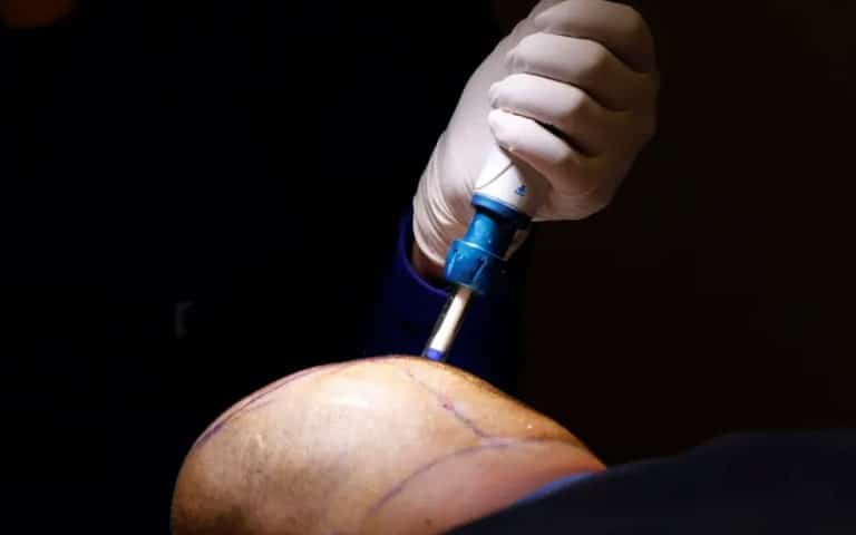 3 Anesthesia and extraction min Women Hair Transplant
