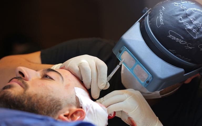 4 implantation min Women Hair Transplant