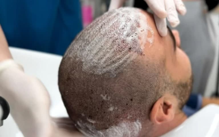 5 Post op care min Women Hair Transplant