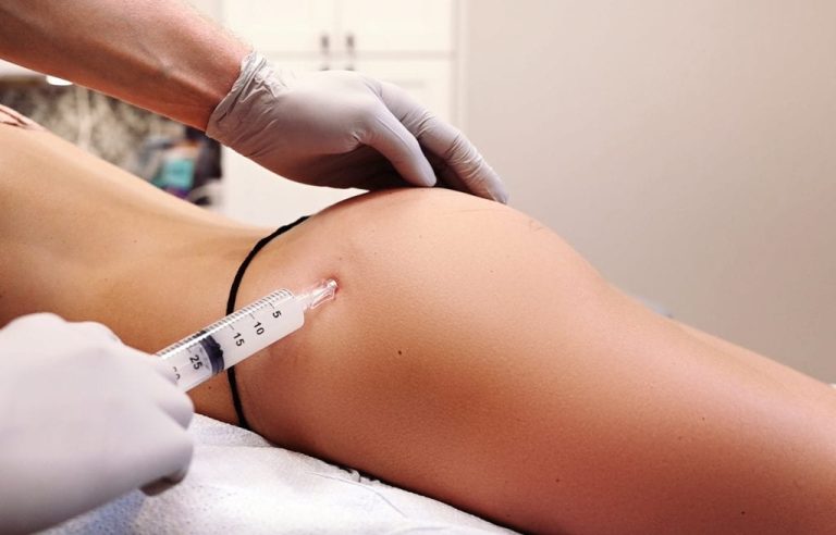 Incision Procedure BBL BBL & le Remodelage Corporel