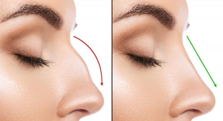 Procedure min 1 Rhinoplasty