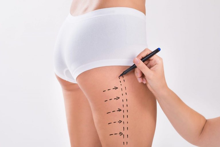Surgical Planning Anesthesia min 1 Thigh Lift