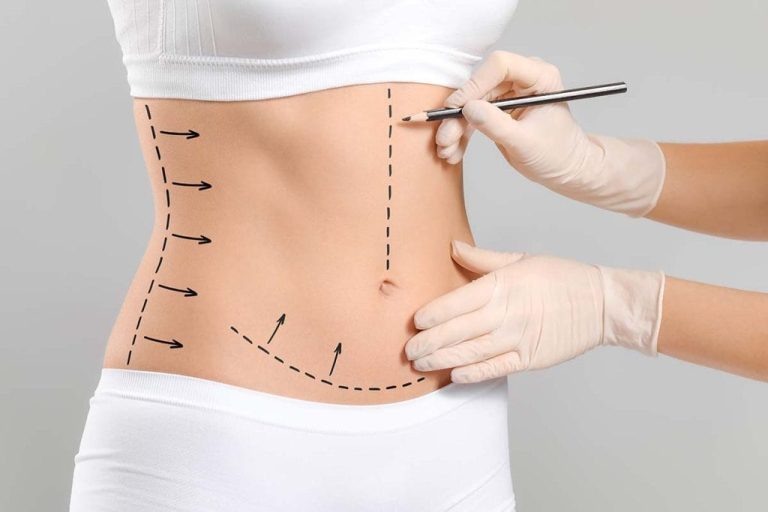 Surgical Planning min Abdominoplastie