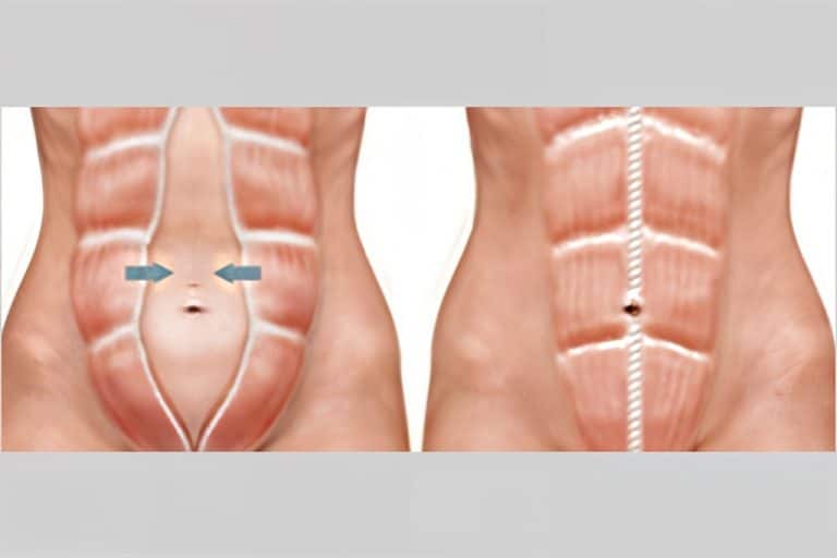 Surgical Planning min min Abdominoplastie
