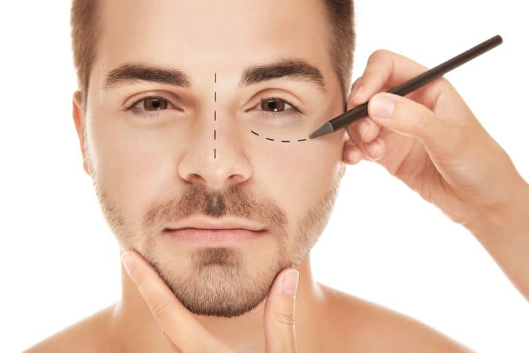 Surgical planning min 2 Blépharoplastie
