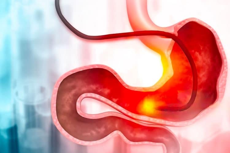 completion min Capsule Gastrique Elipse