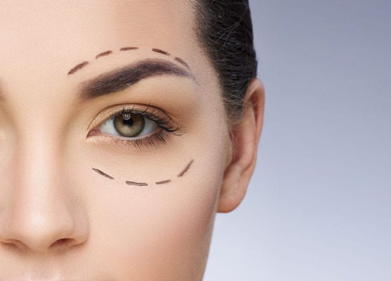 incision min 1 Blépharoplastie