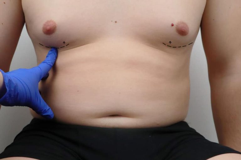 incision min 4 Gynecomastia
