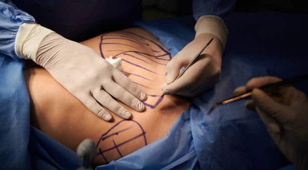 incision min 5 Chirurgie Six Packs
