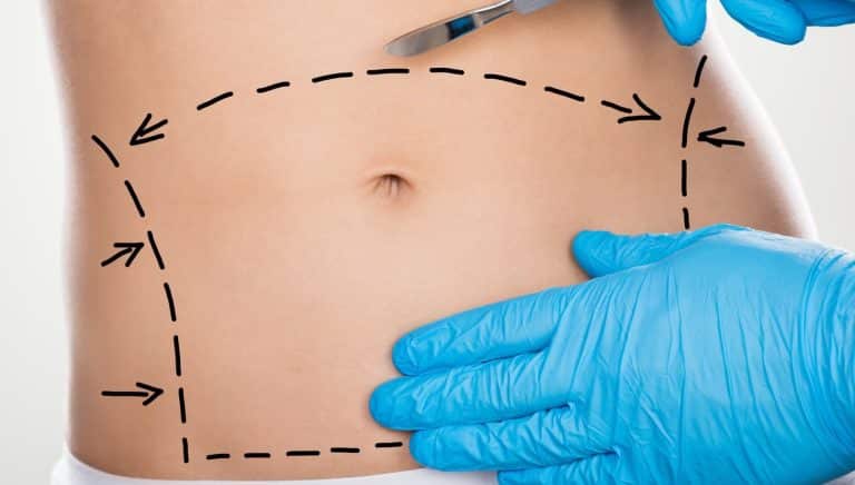incision min Abdominoplastie