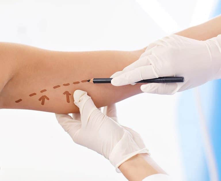 incison and procedure min Lifting des bras