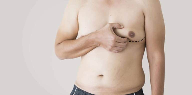 surgical plan min Gynecomastia