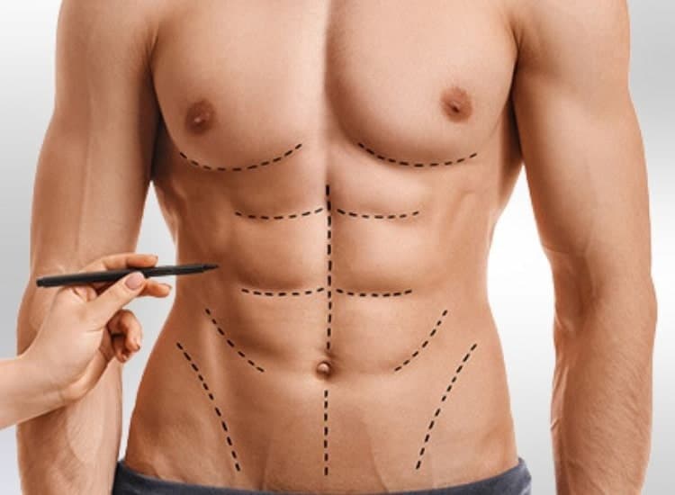 surgical planning min 6 Chirurgie Six Packs