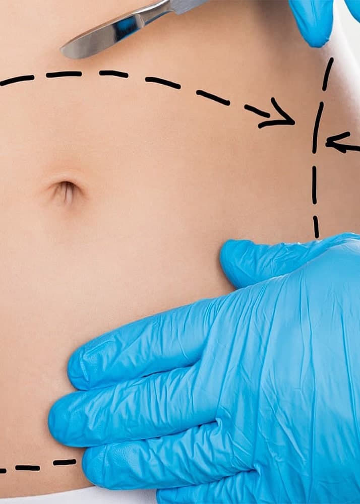 https://essencaclinic.com/wp-content/uploads/2024/12/Abdominolasty3-min.jpg