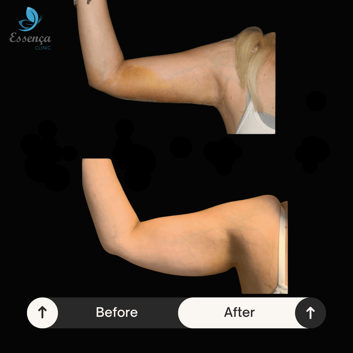 Arm Surgeries 3 min Lifting des bras