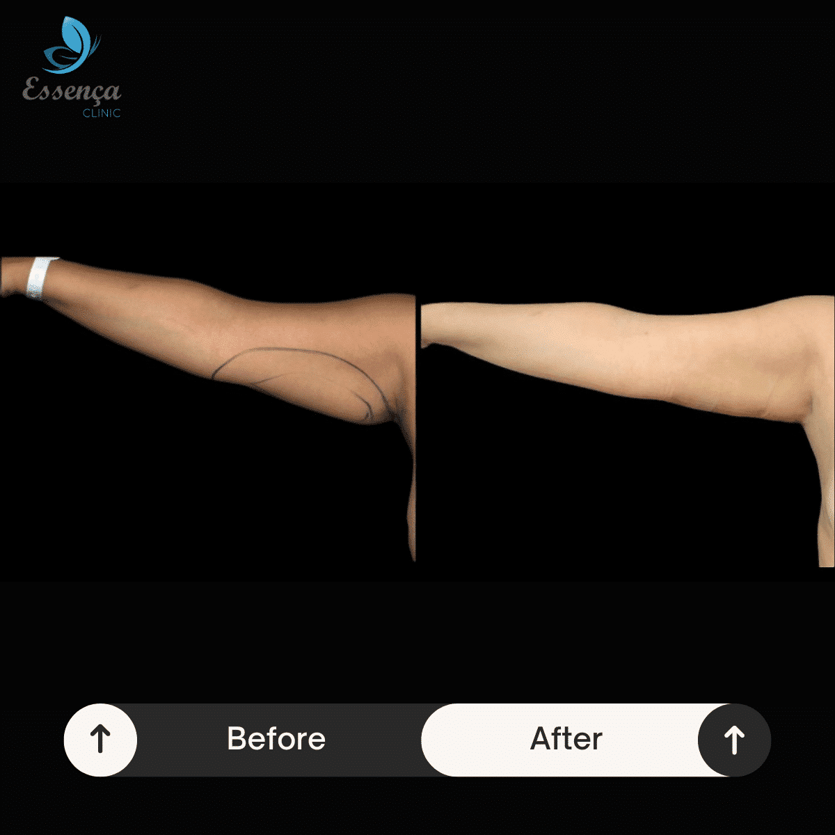 Arm Surgeries 4 min Lifting des bras