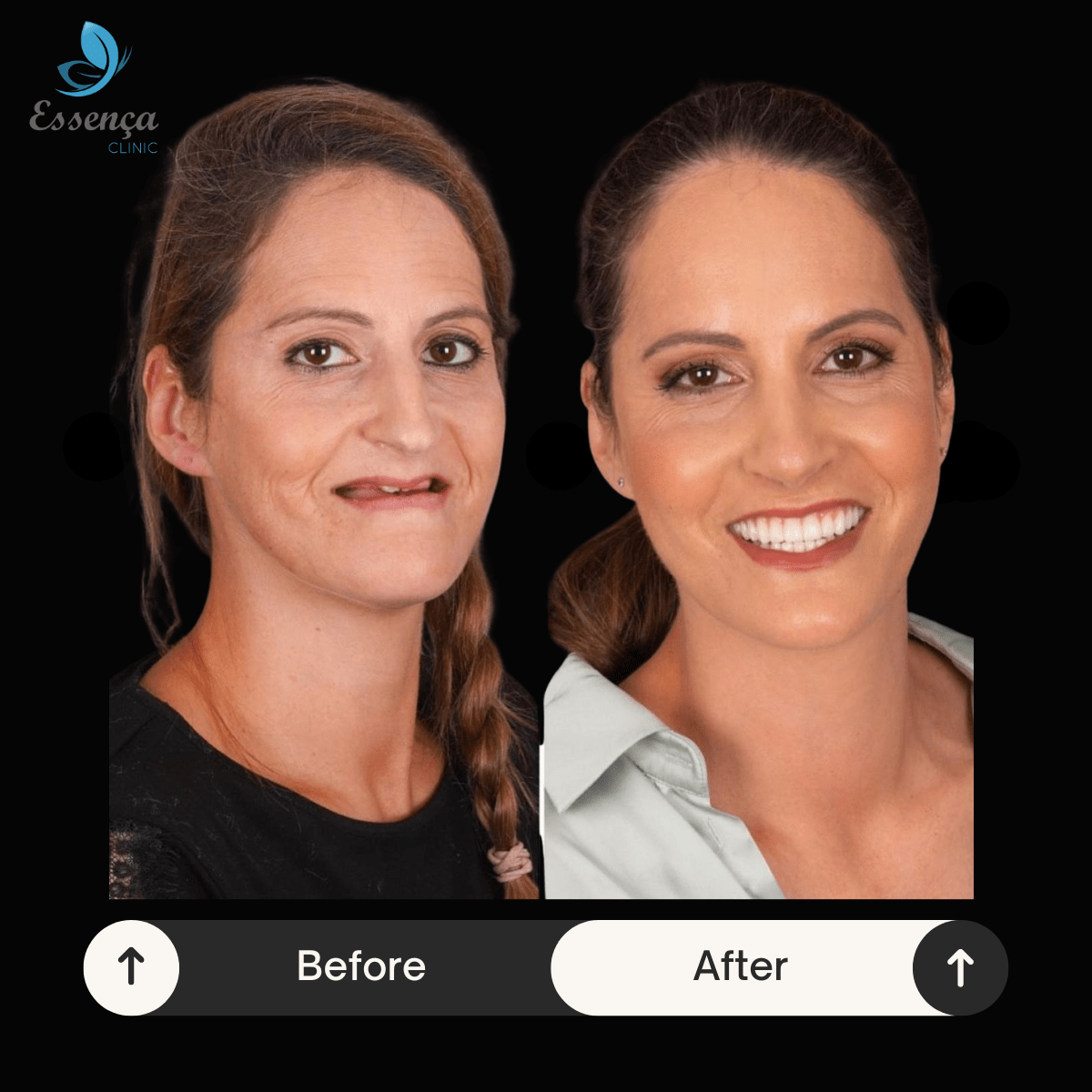 Before After Dental Treatments 16 min Implants