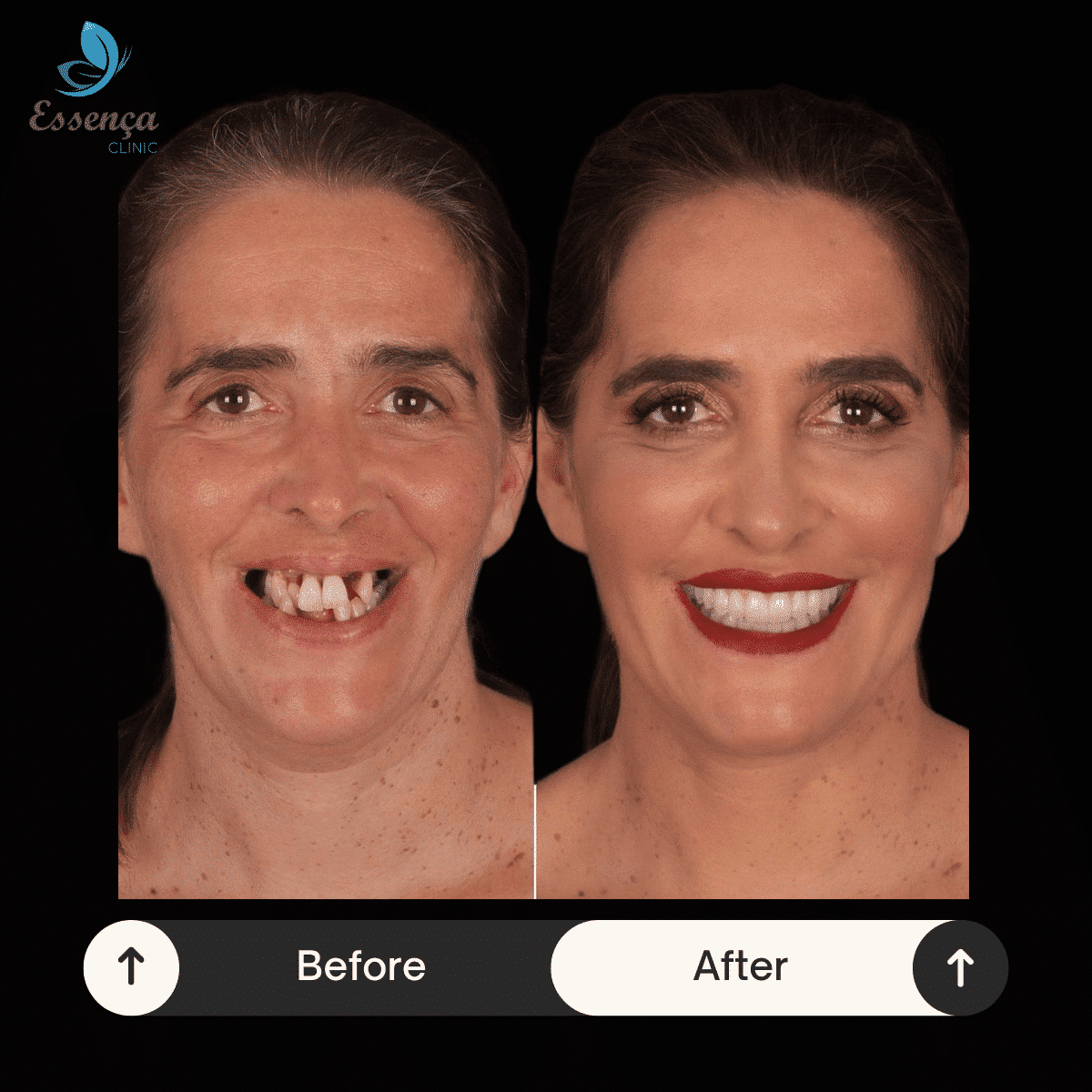 Before After Dental Treatments 18 min Implants