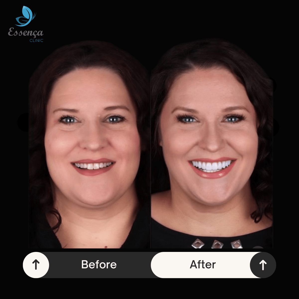 Before After Dental Treatments 2 min Hollywood Smile