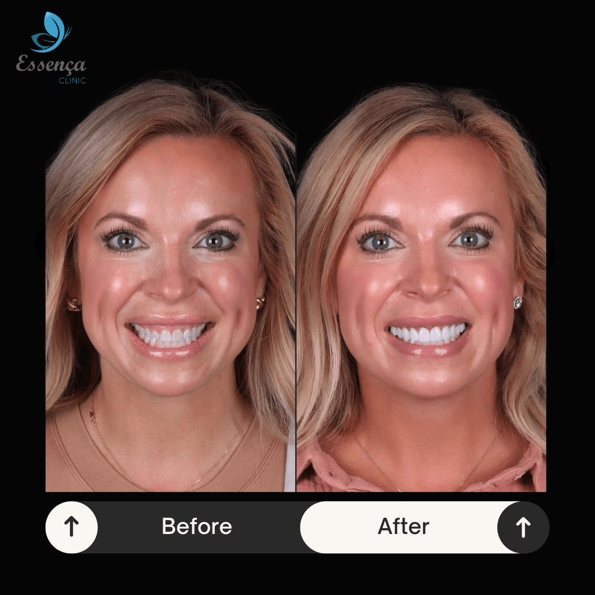 Before After Dental Treatments 5 min Hollywood Smile