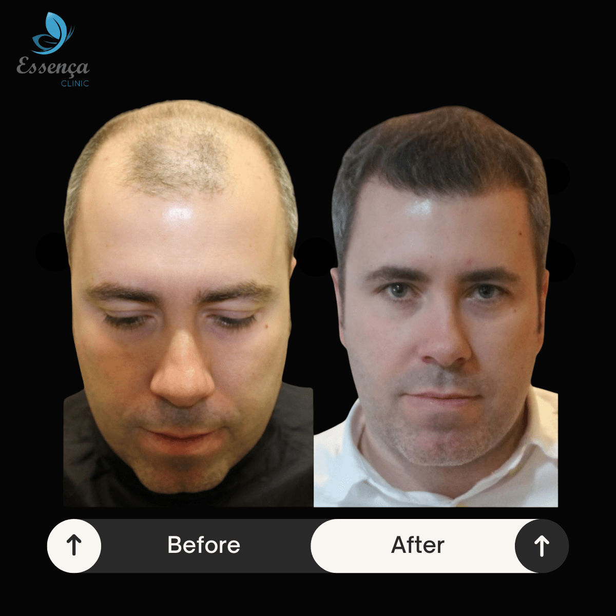 Men Hair Transplant 5 min Greffe de Cheveux