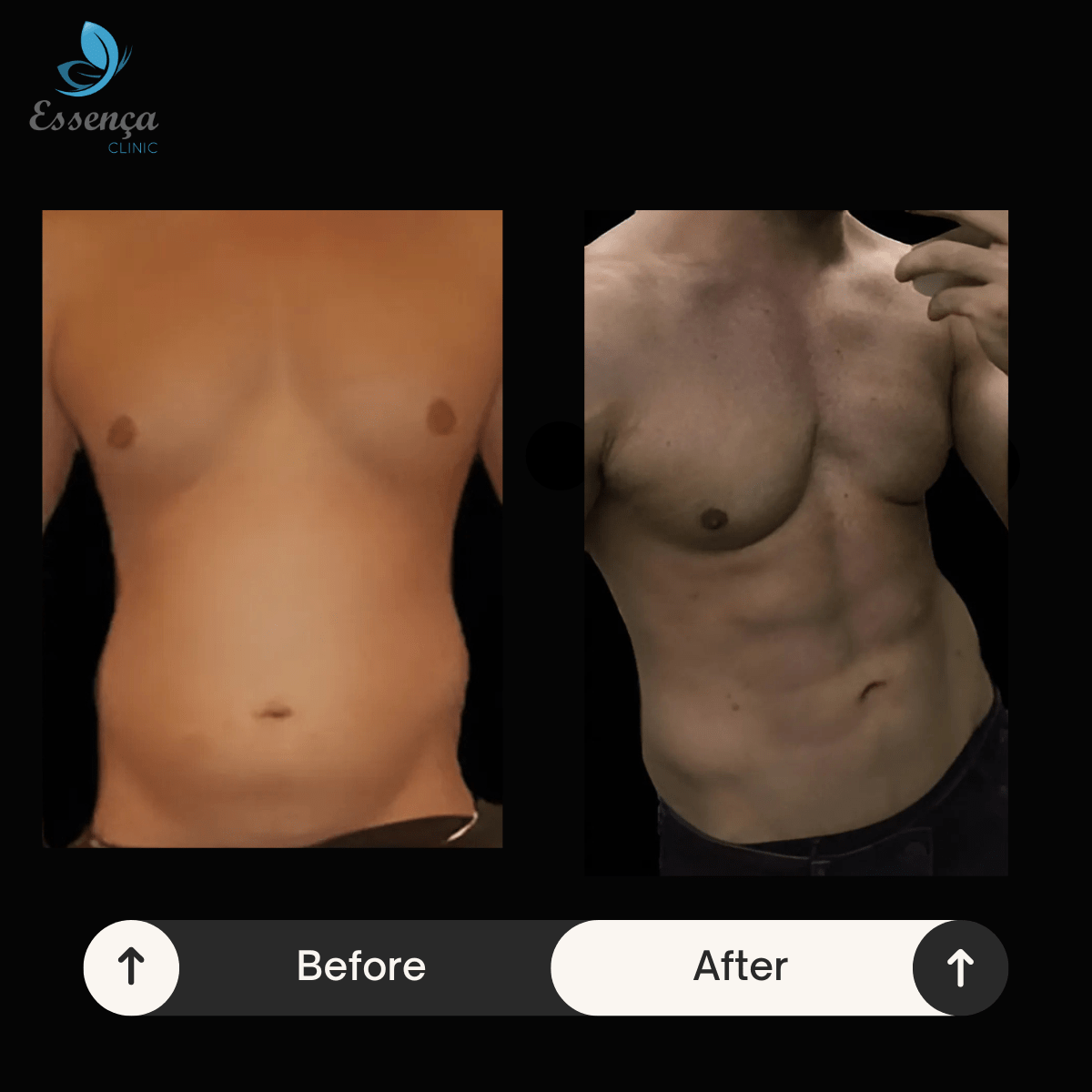 Six Packs Surgery 2 min Lifting Temporal