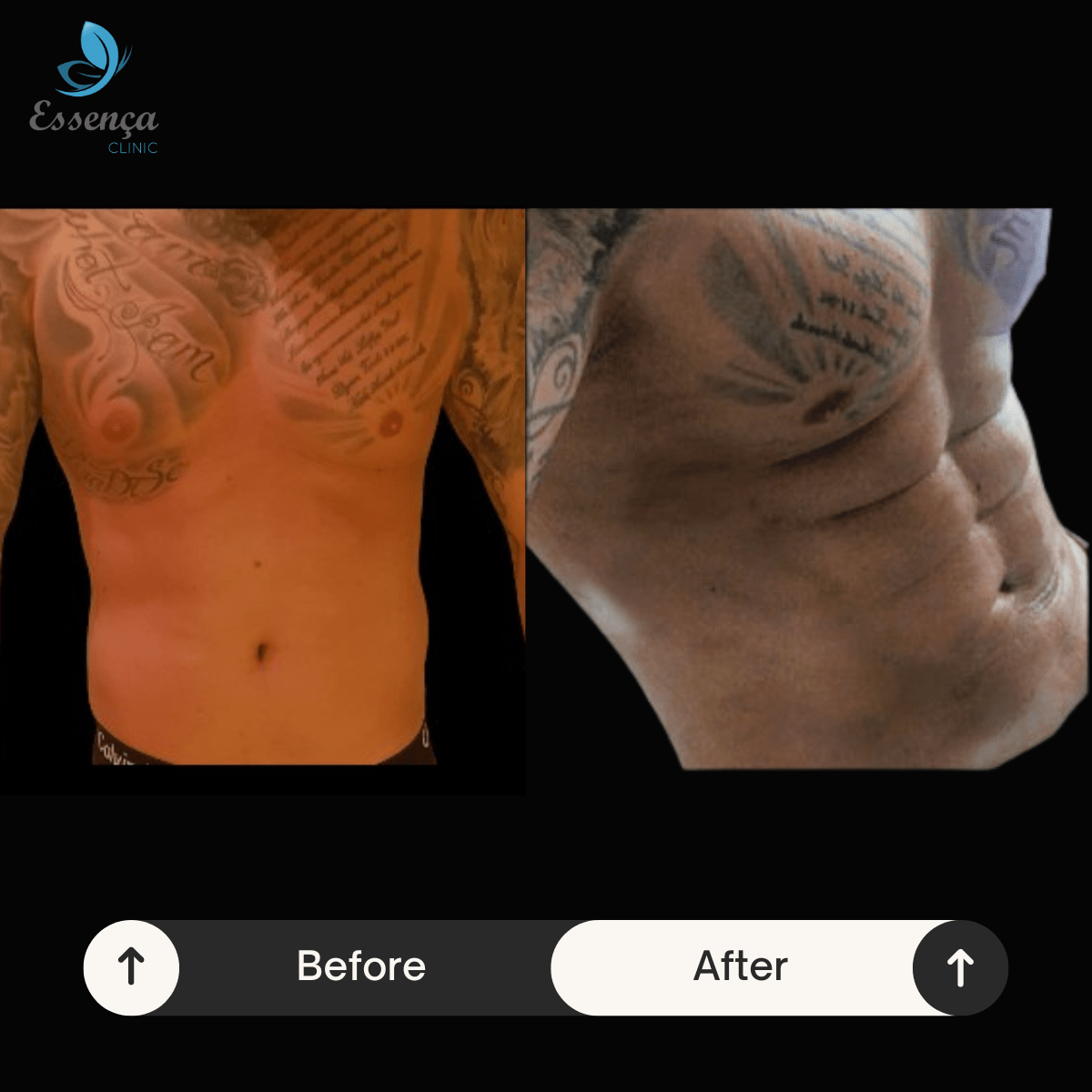 Six Packs Surgery 3 min Lifting Temporal