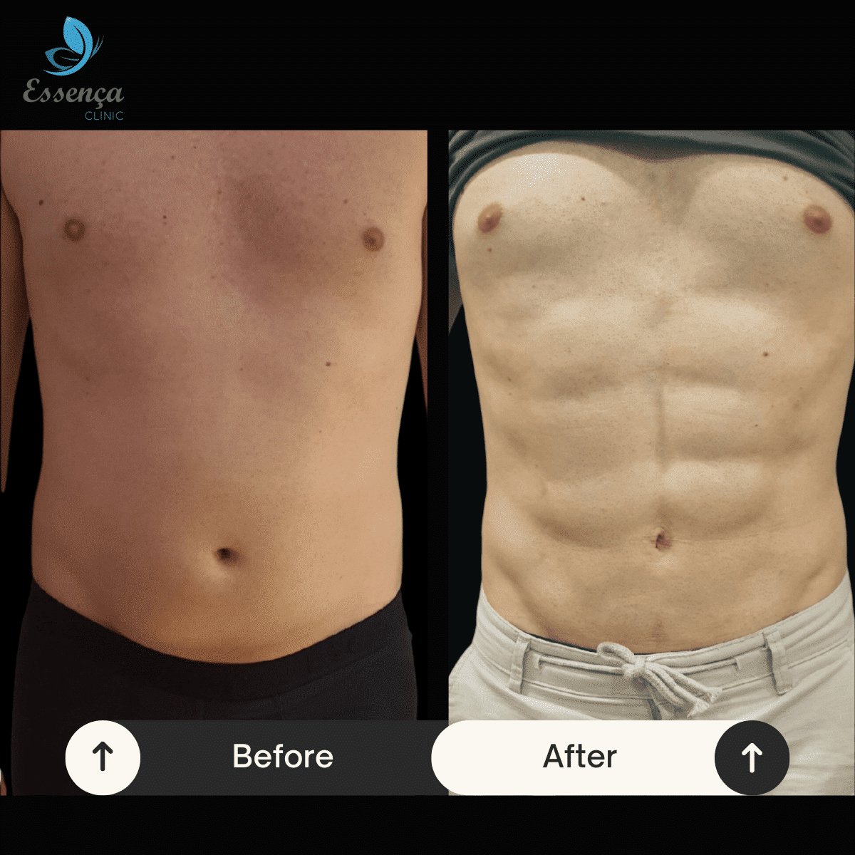Six Packs Surgery 6 min Lifting Temporal