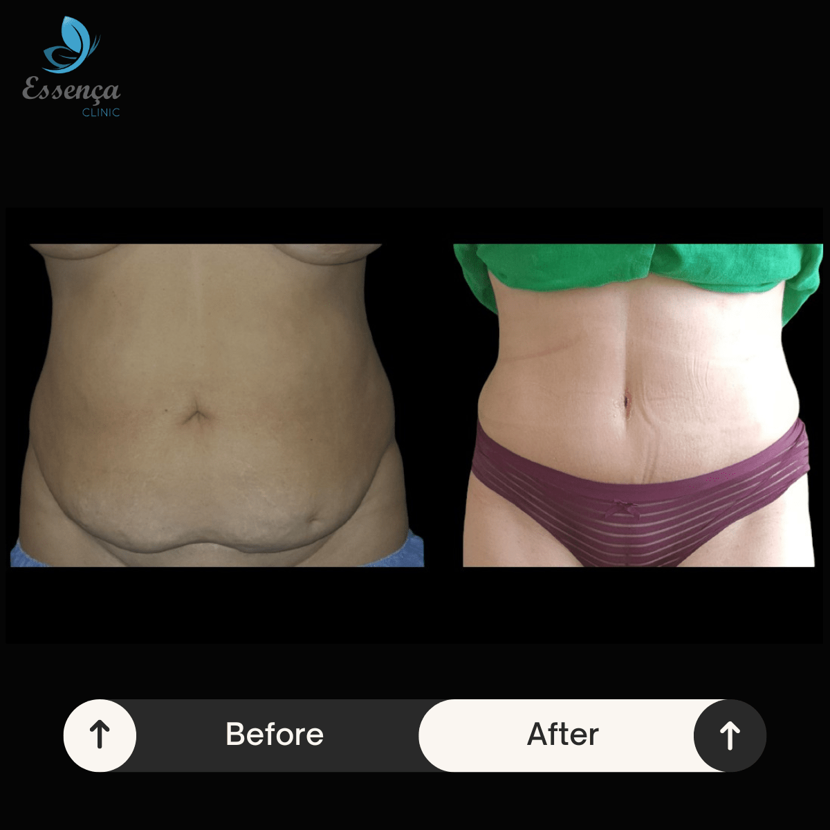 Tummy Tuck Abdominoplasty 3 min Abdominoplastie