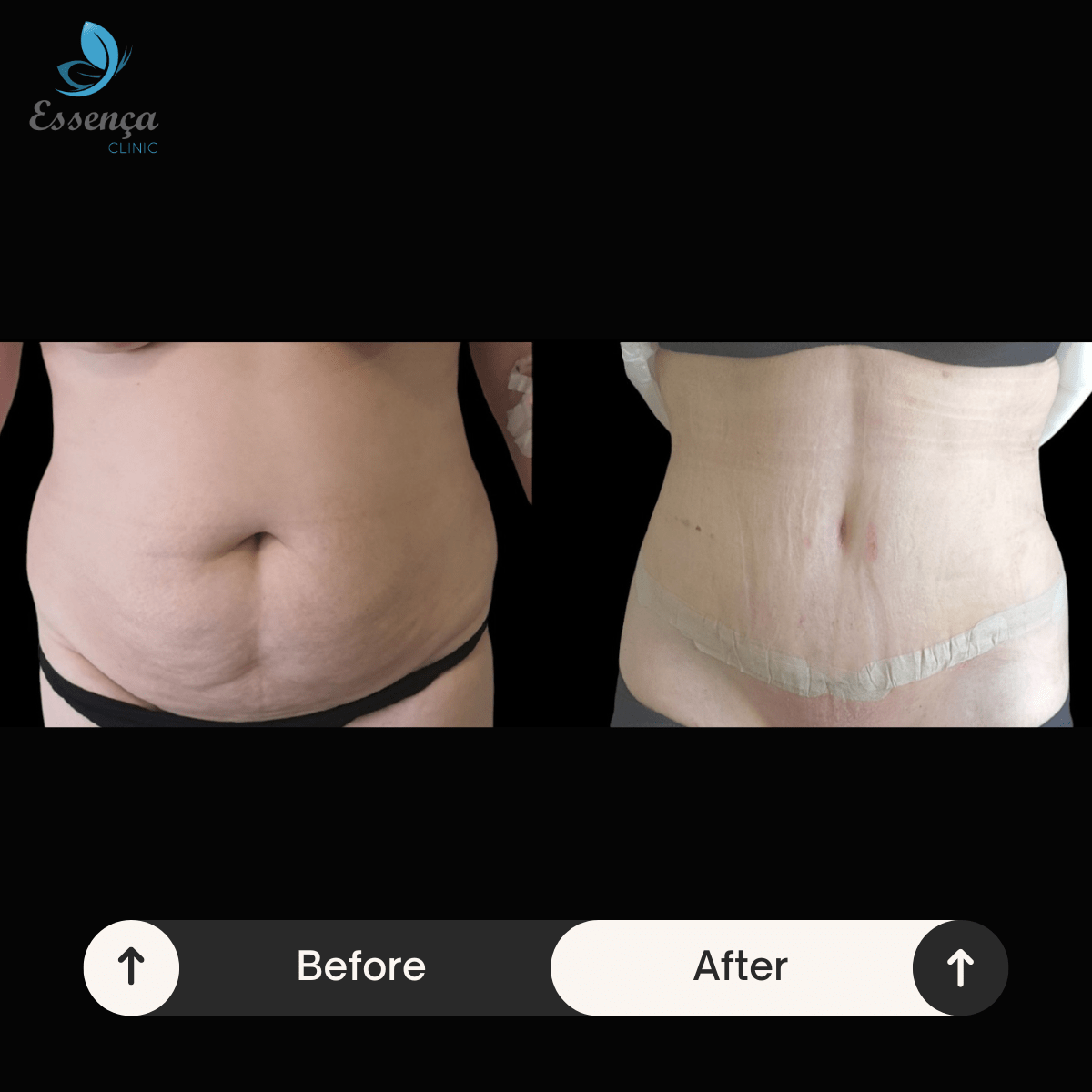 Tummy Tuck Abdominoplasty 4 min Abdominoplastie
