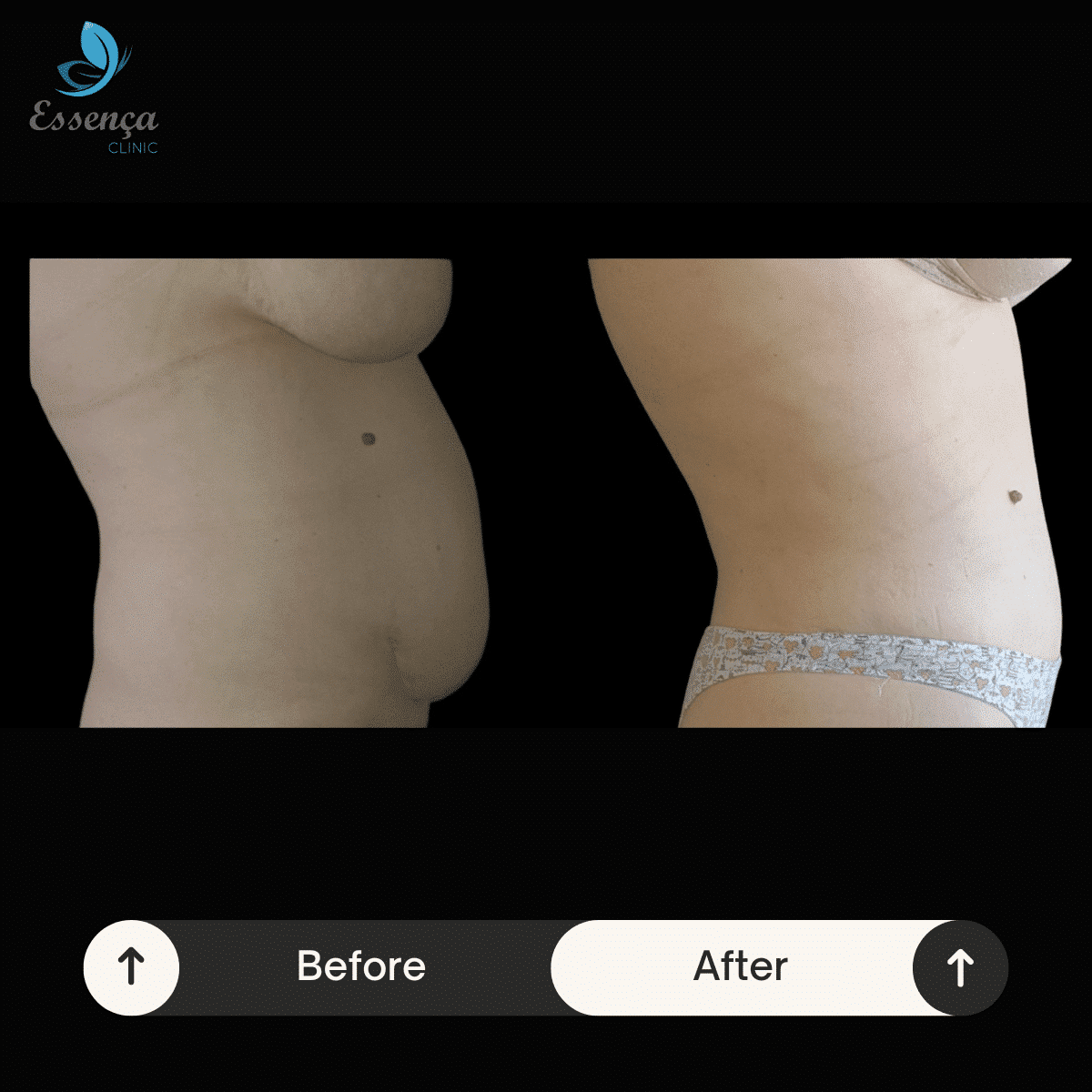 Tummy Tuck Abdominoplasty 5 min Abdominoplastie