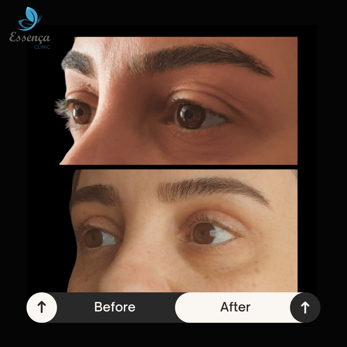 Untitled design 58 min Blépharoplastie