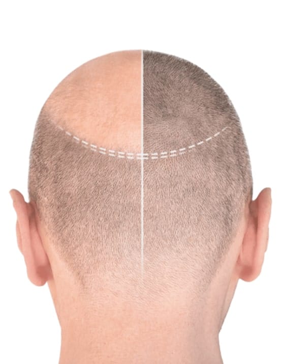https://essencaclinic.com/wp-content/uploads/2024/12/What-is-a-Hair-Transplant-min.jpg