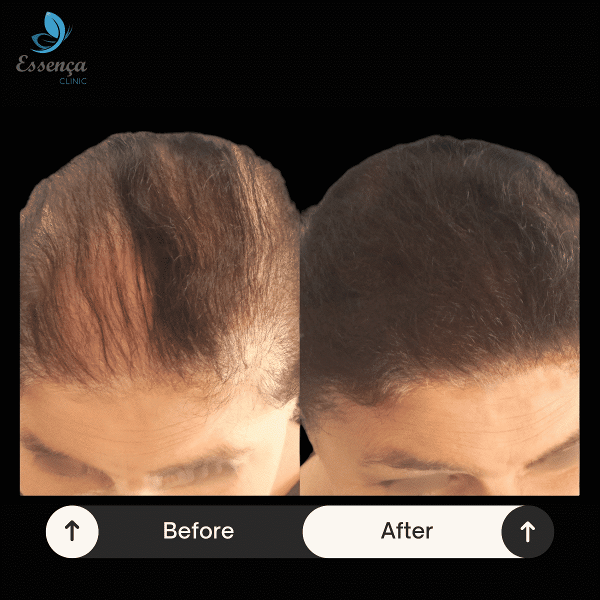 Women Hair Transplant 4 min Women Hair Transplant