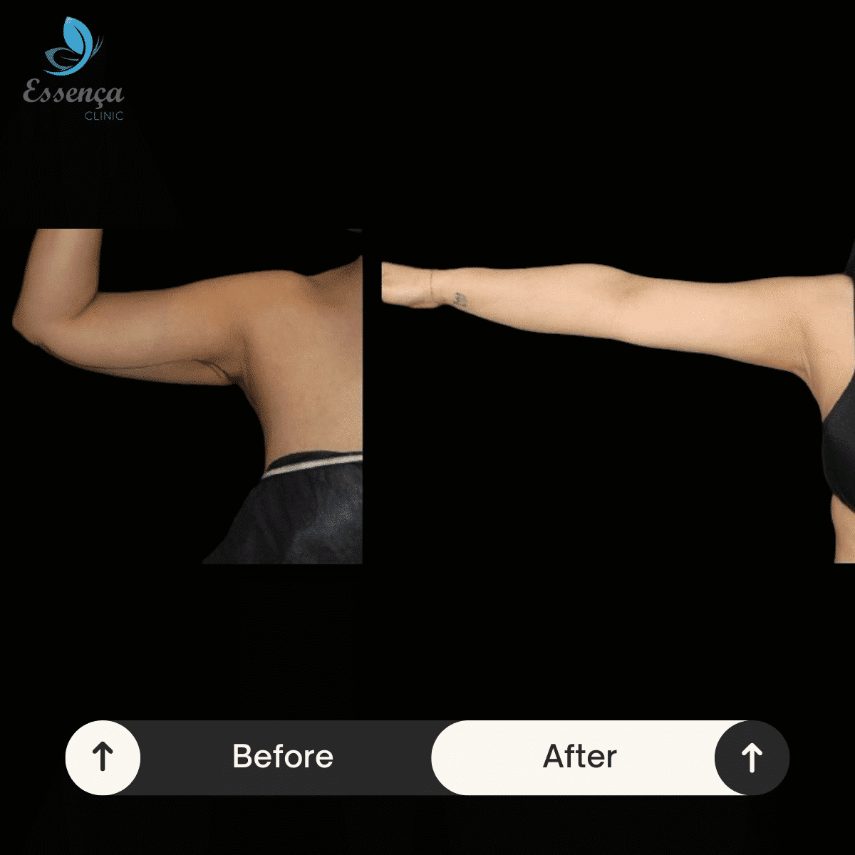 Arm Surgeries (1)-min