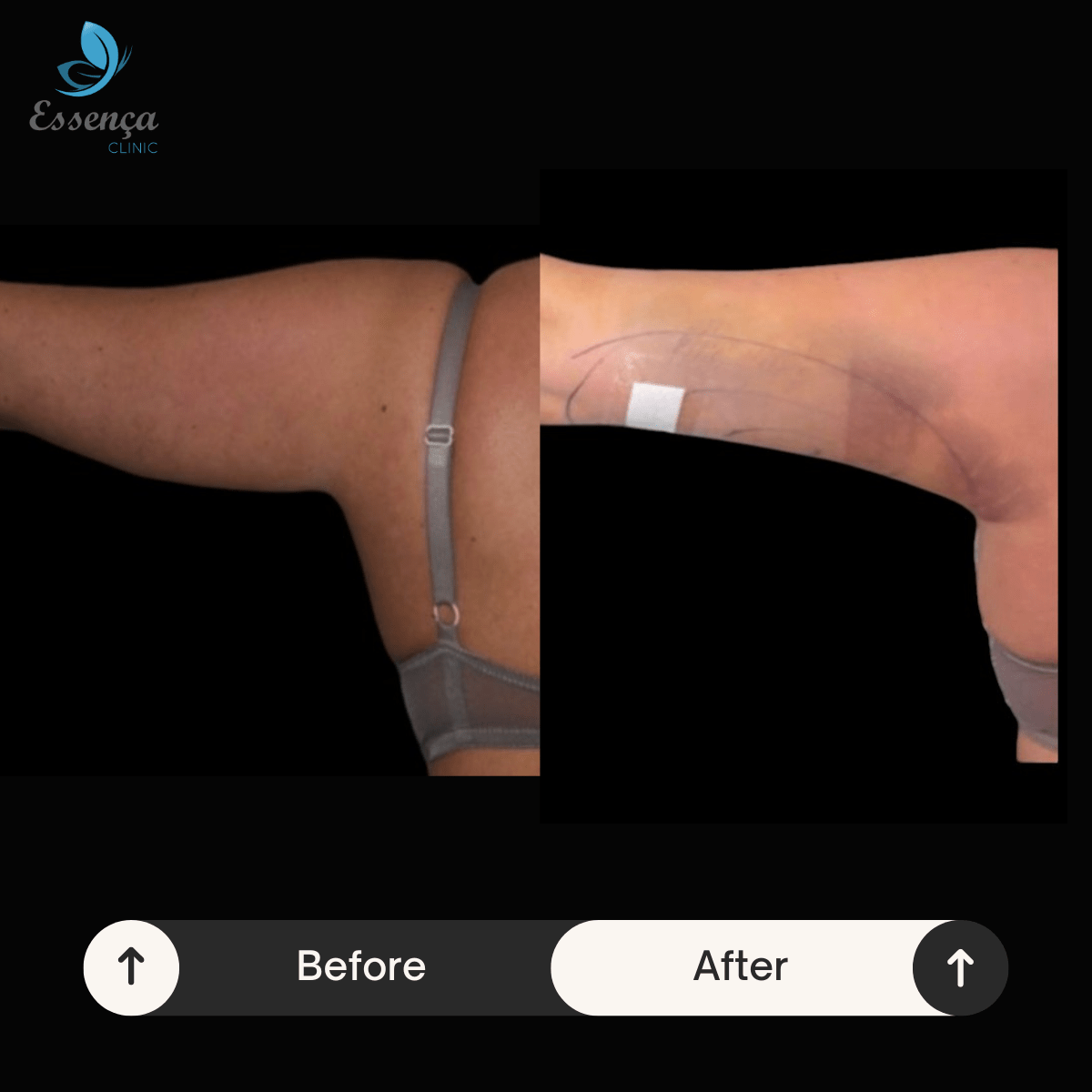 Arm Surgeries (5)-min