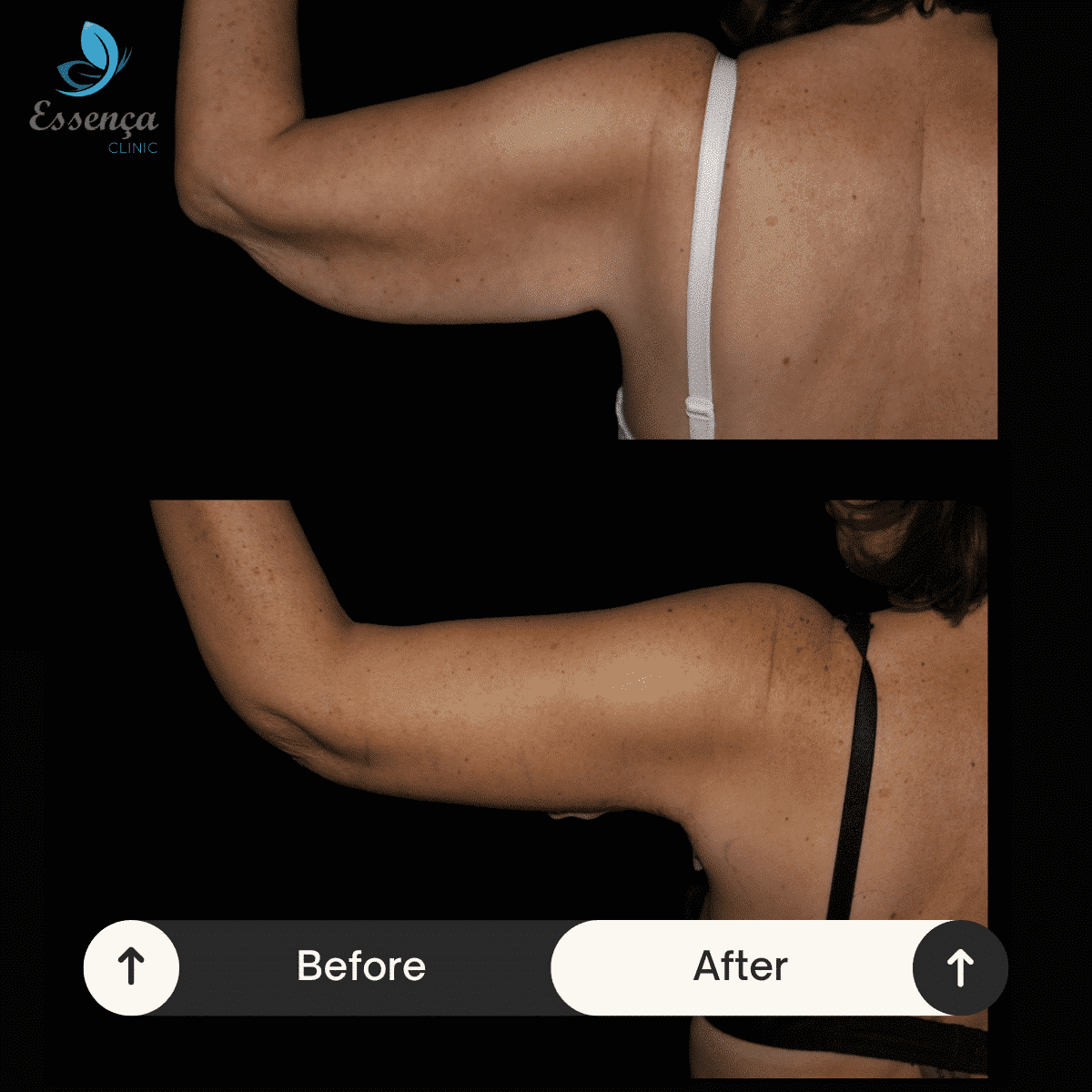 Arm Surgeries (7)-min
