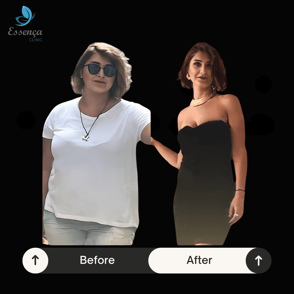Before After Bariatric Surgery (3)