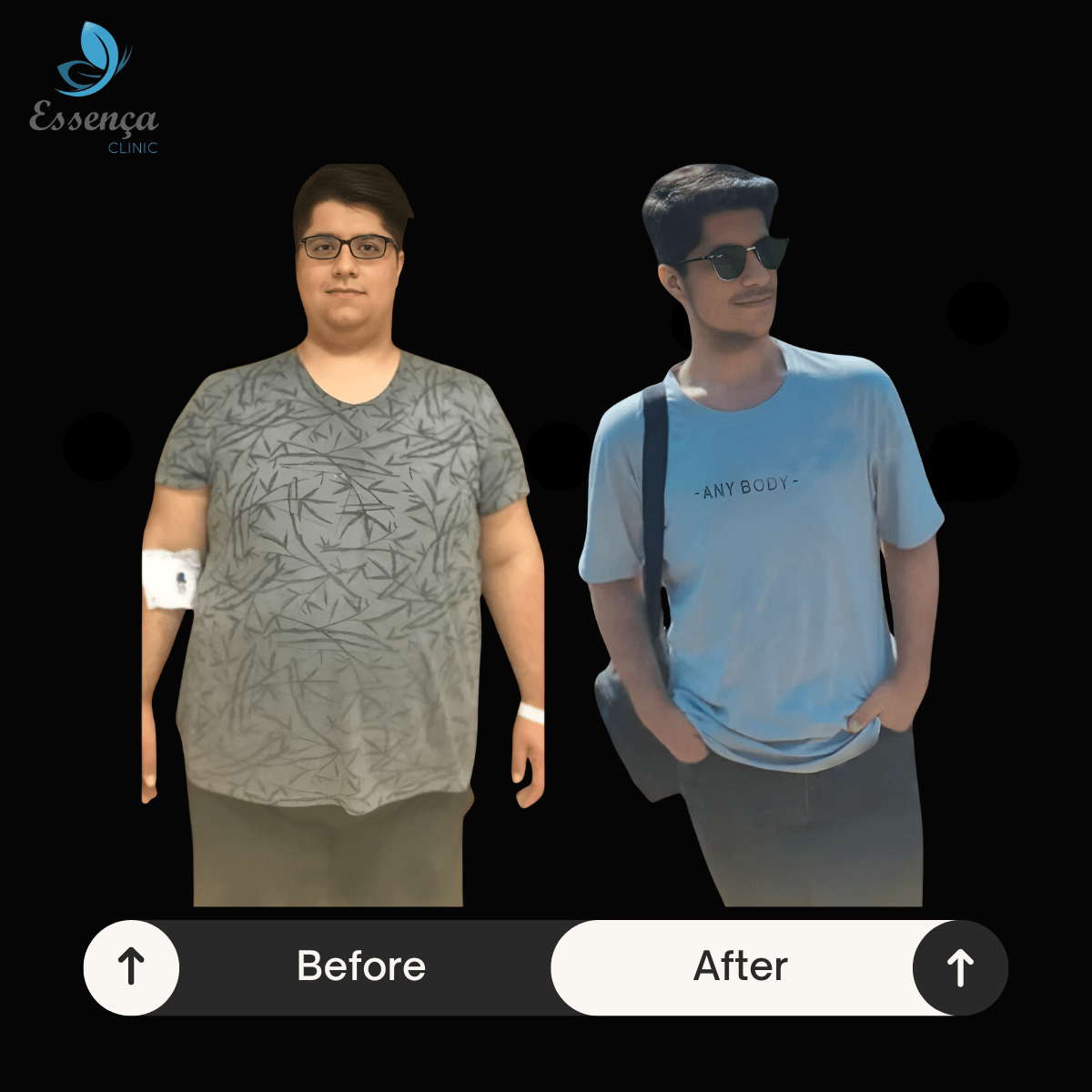 Before After Bariatric Surgery 6 min Sleeve Gastrique