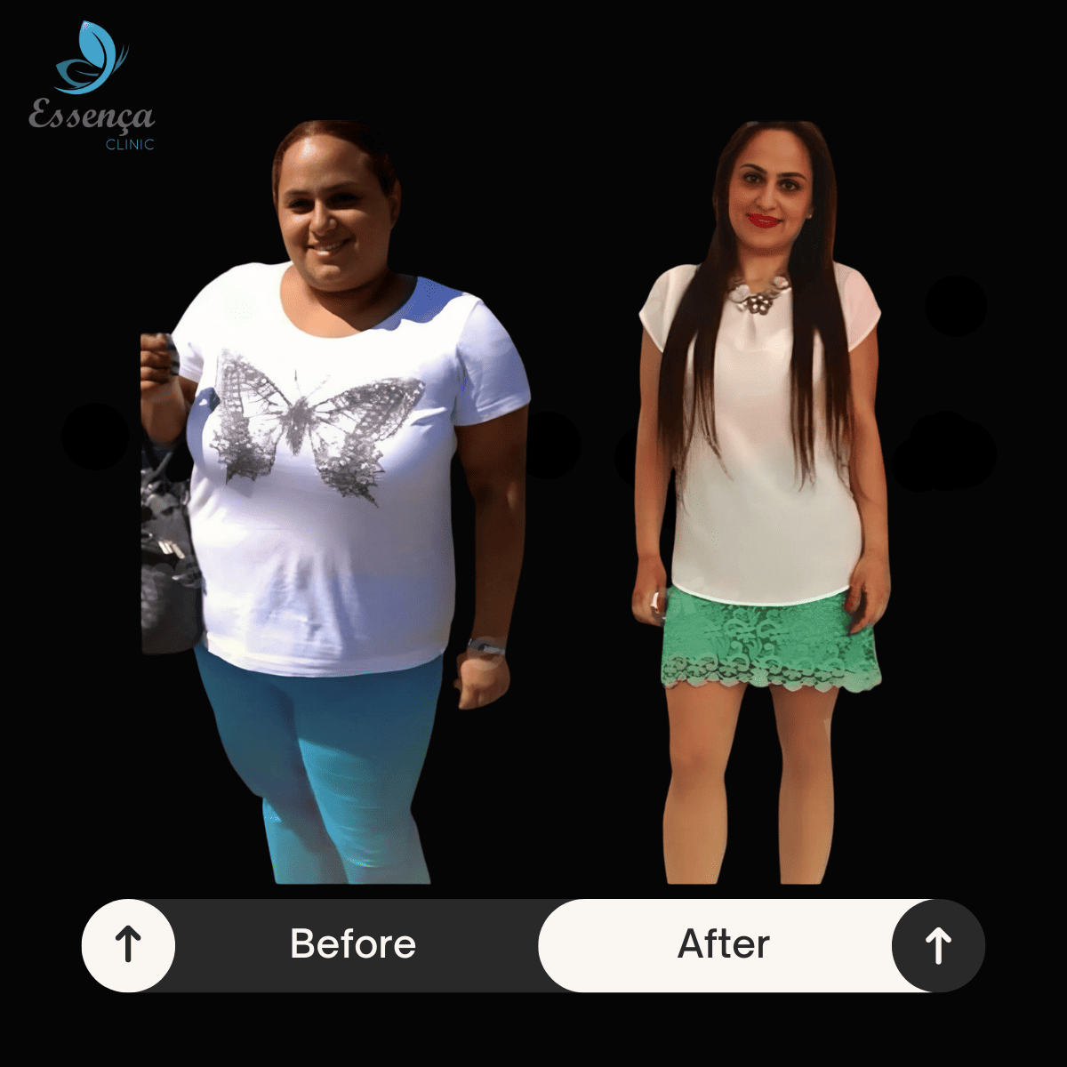 Before After Bariatric Surgery (7)