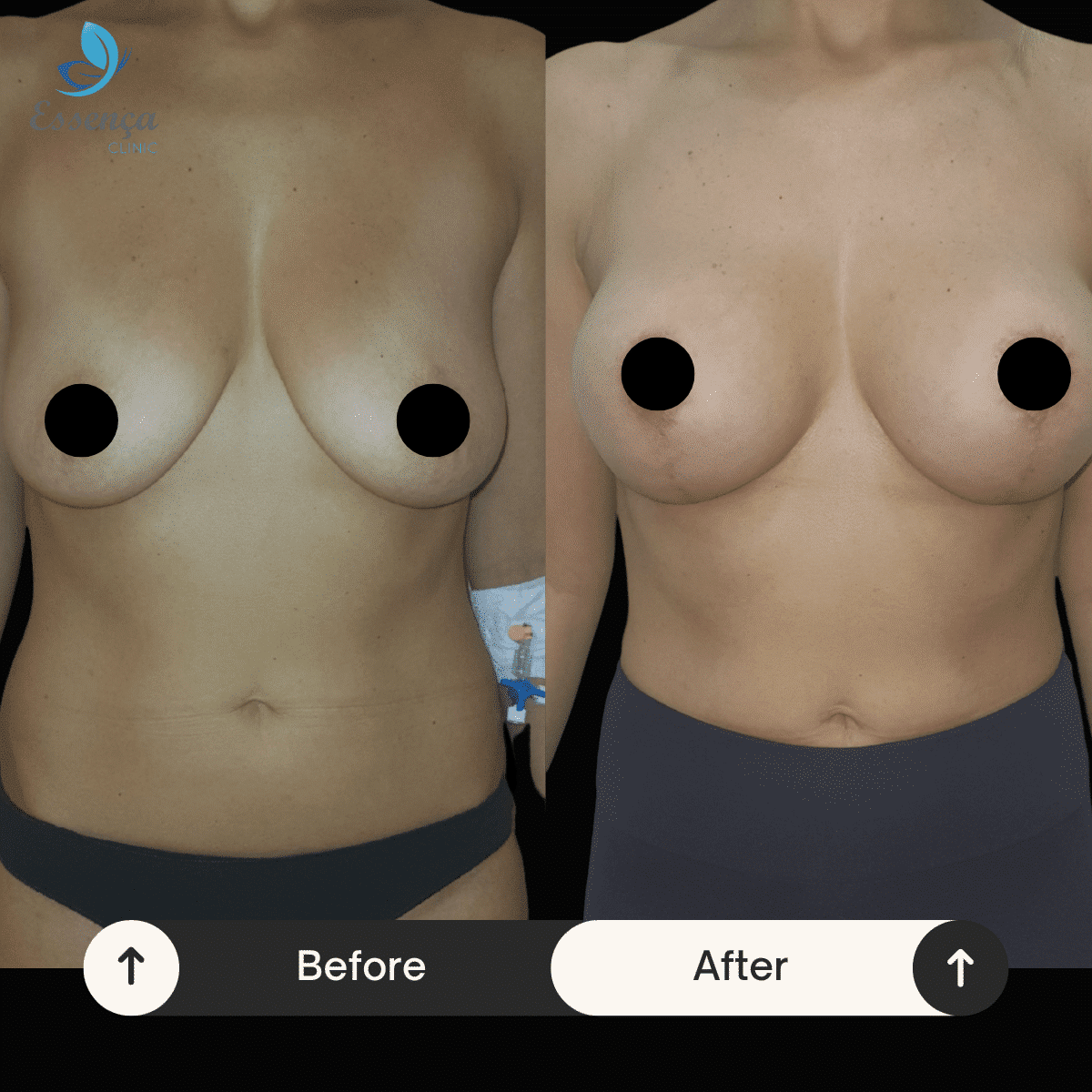 Before After Dr. Burak Efeoğlu (10)-min