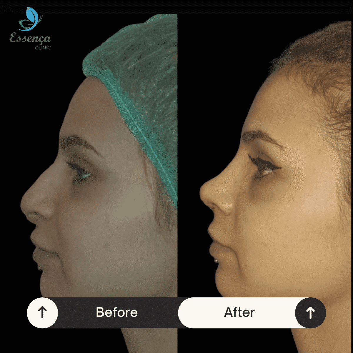 Before After Dr. Burak Efeoğlu (12)-min