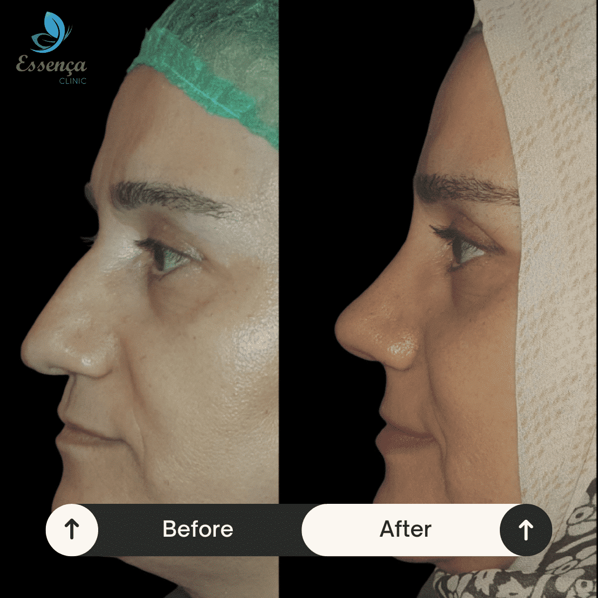 Before After Dr. Burak Efeoğlu (13)-min