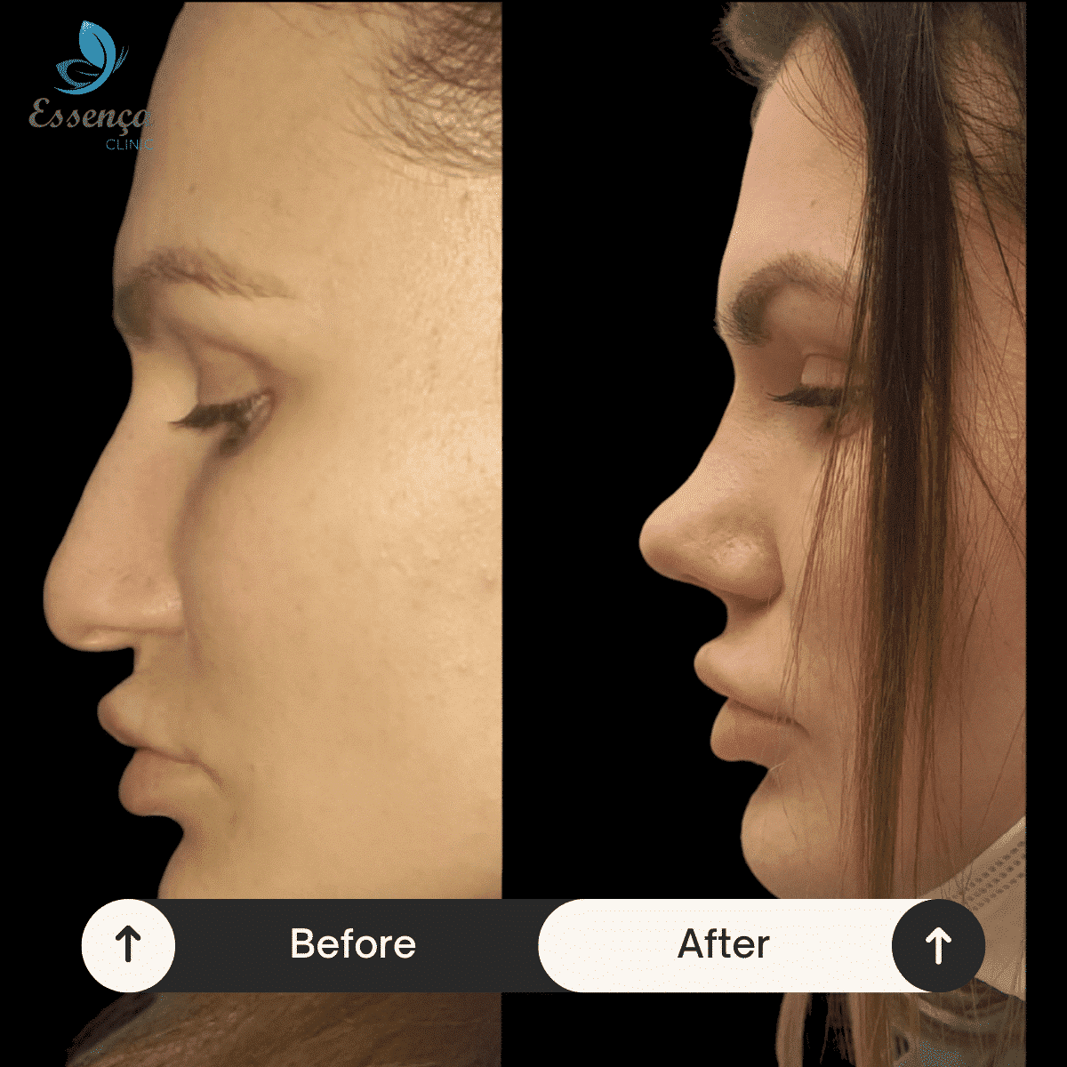 Before After Dr. Burak Efeoğlu (15)-min
