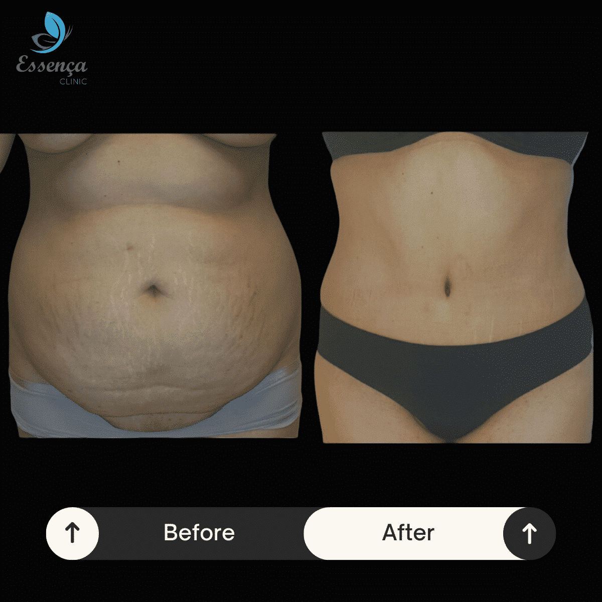 Before After Dr. Burak Efeoğlu (19)-min