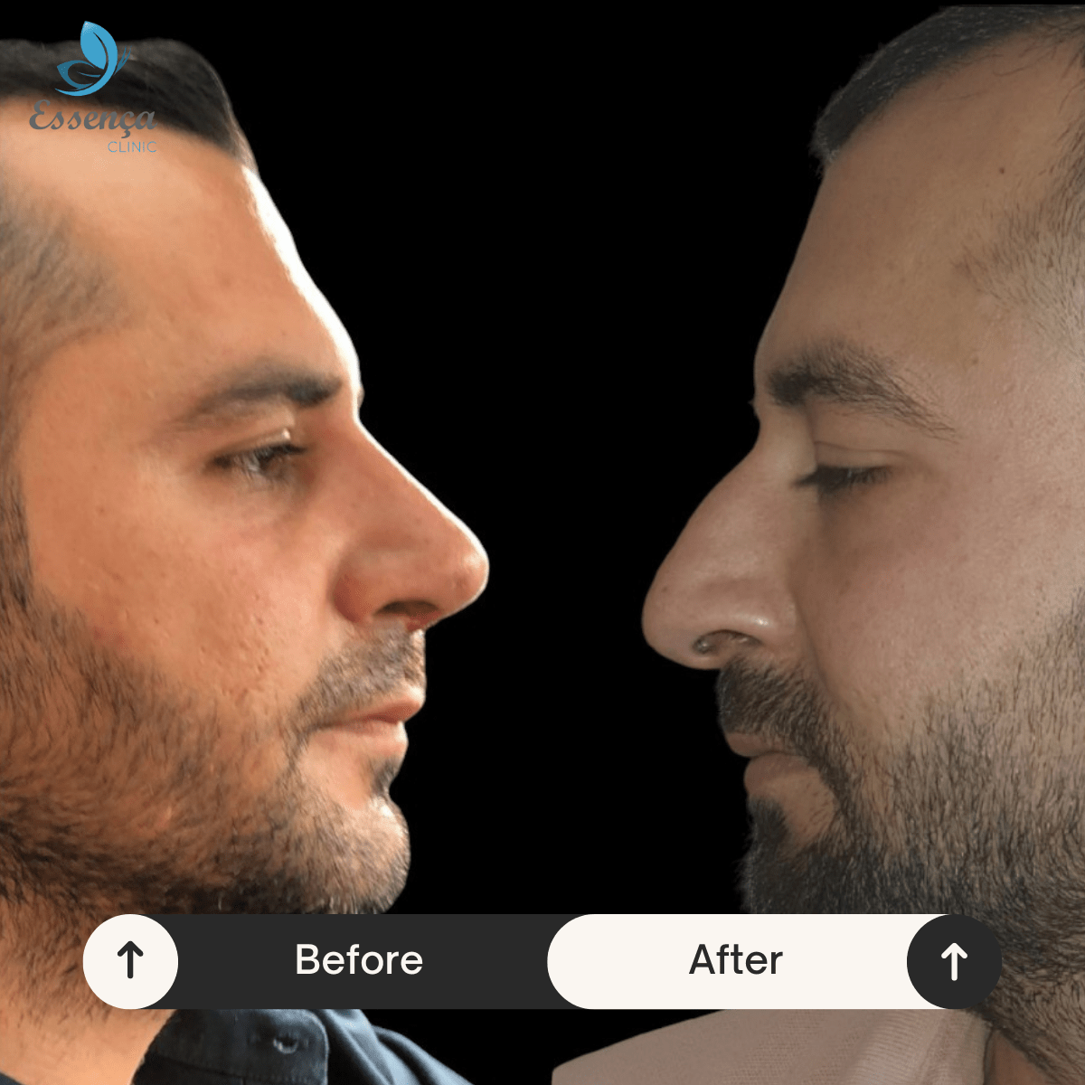 Before After Dr. Burak Efeoğlu (24)-min