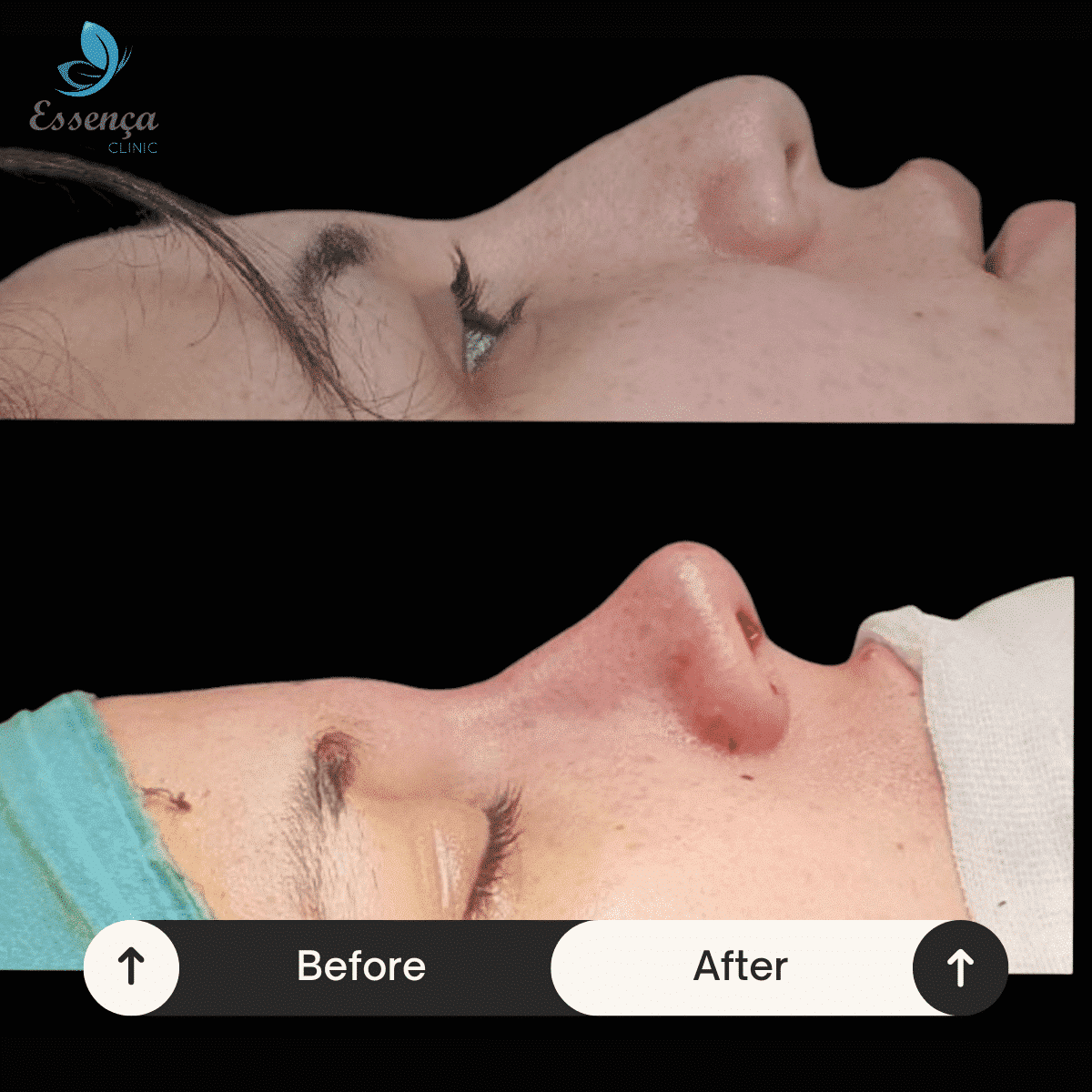 Before After Dr. Burak Efeoğlu (25)-min