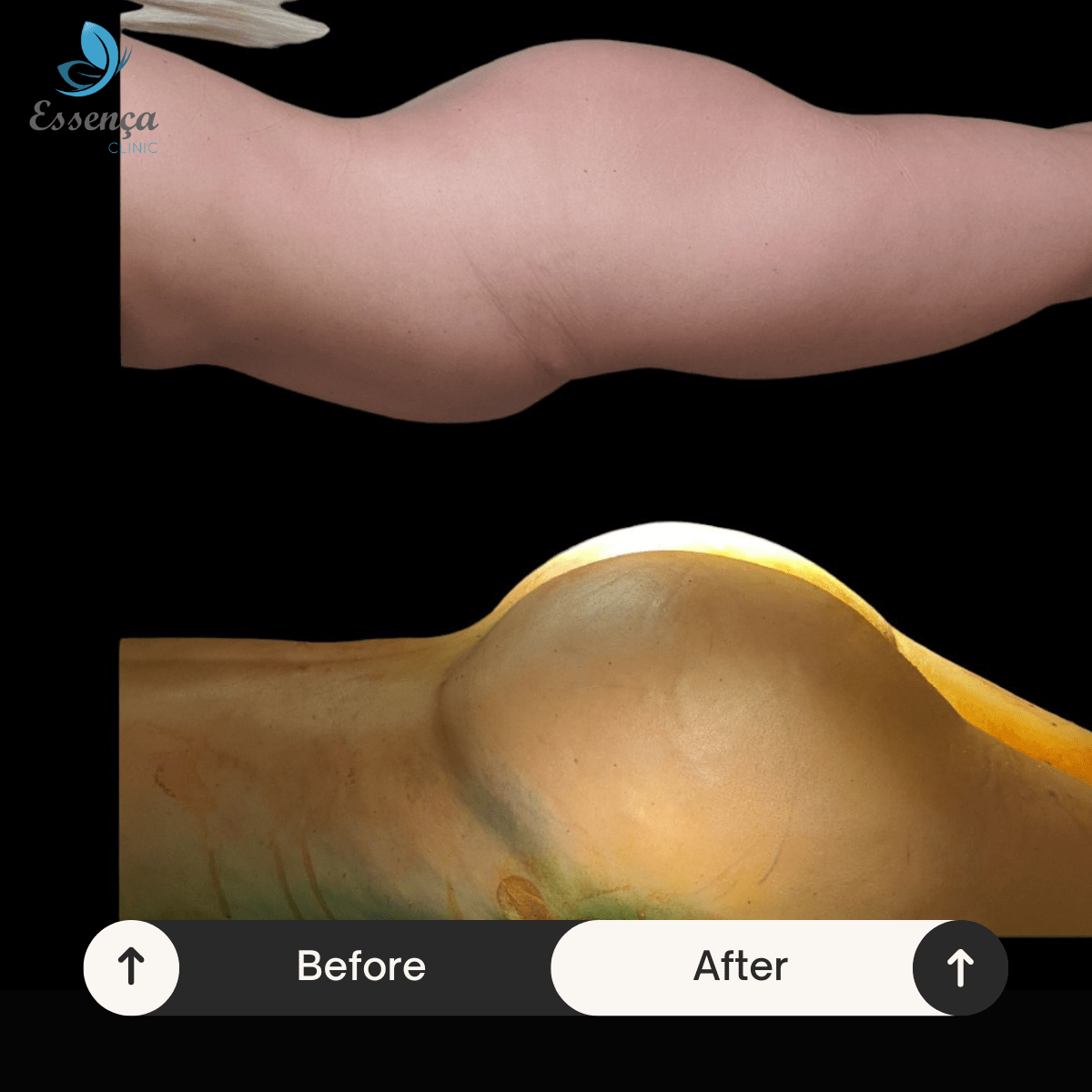 Before After Dr. Burak Efeoğlu (26)-min