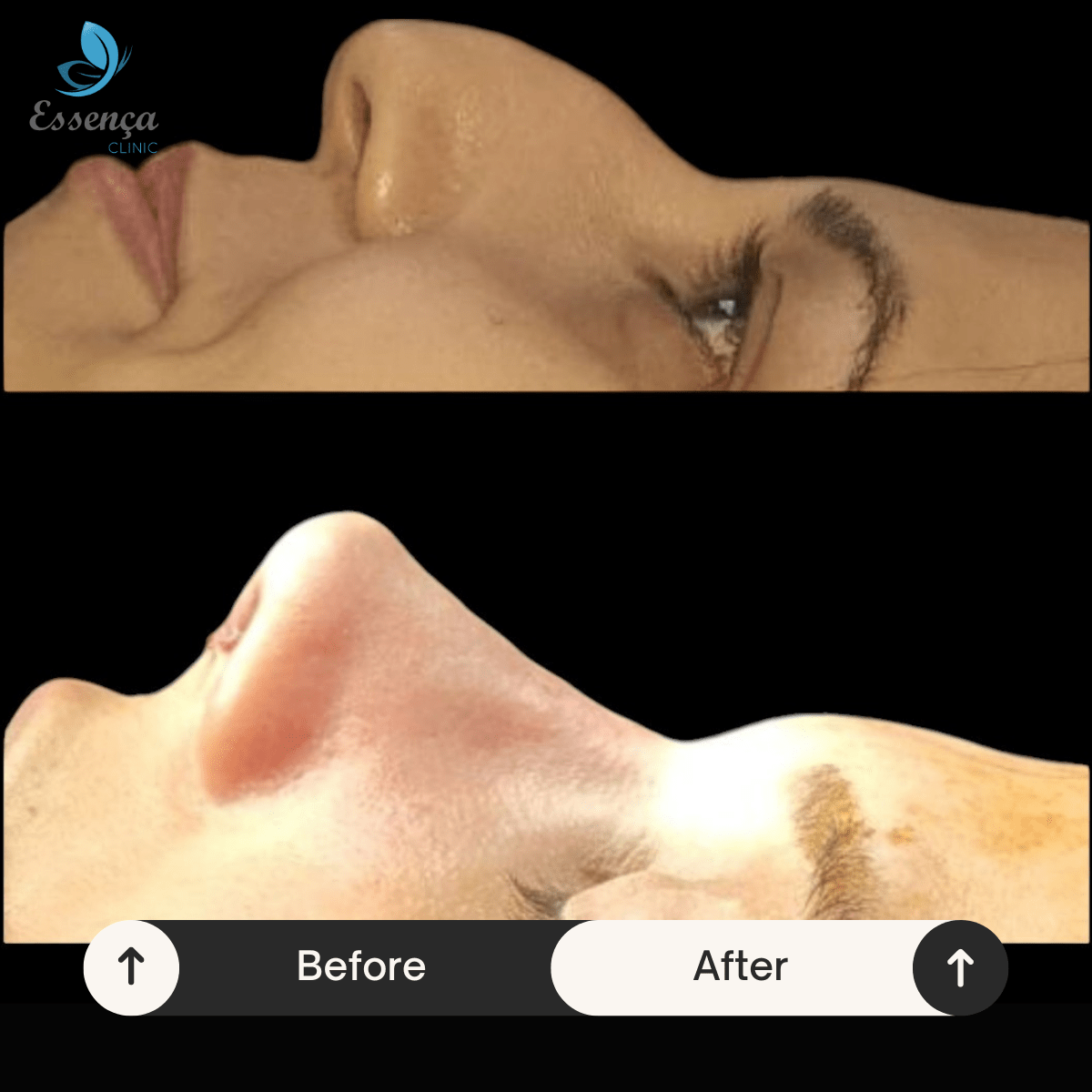 Before After Dr. Burak Efeoğlu (28)-min