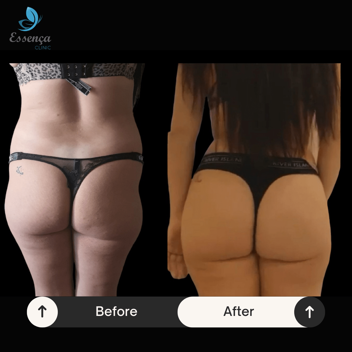 Before After Dr. Burak Efeoğlu (29)-min